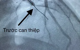 10 phút can thiệp cứu sống bệnh nhân nhồi máu cơ tim biến chứng ngưng tim