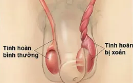 Đau tinh hoàn nhưng không viện điều trị, thiếu niên ở Quảng Ninh phải cắt tinh hoàn