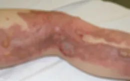 Người đàn ông bỏng nặng do... nướng mực bằng cồn
