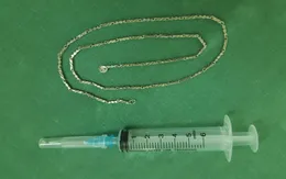 Lấy sợi dây chuyền dài gần 40 cm trong dạ dày của bé 2 tuổi