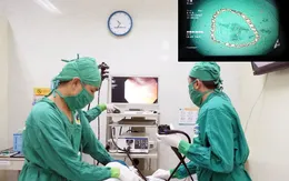 Bé gái 5 tuổi nuốt sợi lắc bạc gần 20cm vào dạ dày