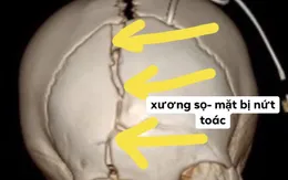 Cửa kính đè lên người, bé trai bị chấn thương sọ não