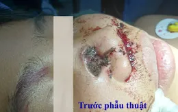 Bé trai ở Miền Tây bị khúc gỗ đâm xuyên thấu mũi