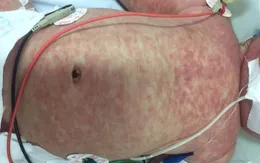 Không chủ quan với bệnh sởi
