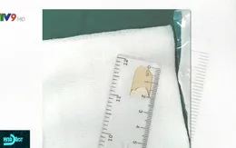 Bé gái 8 tháng tuổi nuốt mảnh thủy tinh từ ống thuốc vỡ