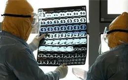 Lần đầu phát hiện virus gây bệnh COVID-19 trong não tủy bệnh nhân