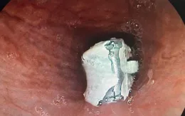 Nội soi lấy đầu khóa áo trong thực quản bé 6 tuổi