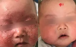 Đừng chủ quan với dấu hiệu viêm da ở trẻ