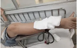 Trẻ bị đứt gân chân, gãy xương, bỏng nặng... - Hãy cẩn trọng bảo vệ trẻ trong mùa dịch!