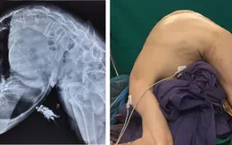 Nắn chỉnh biến dạng cột sống bệnh nhân "siêu gù"
