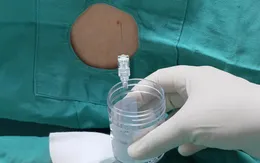 Bé trai 4 tuổi bị viêm màng não do nhiễm giun đũa chó, mèo