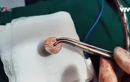 Cứu sống nam bệnh nhân bị hóc đồng xu đường thở