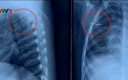 Liên tiếp xảy ra tai nạn nguy hiểm ở trẻ nhỏ