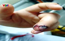 Bé trai 6 tuổi người Nga bị dập nát ngón tay khi kẹp vào cửa