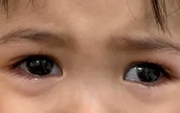 Chớ xem thường khi trẻ bị lé