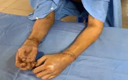 Cứu người đàn ông đứt rời 2 bàn tay, vết thương sọ não