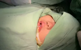 Khám, phẫu thuật khe hở môi, vòm miệng miễn phí tại Quảng Ngãi