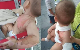 Chơi cùng anh trai, bé 2 tuổi bị tô mì tôm đổ úp vào người gây bỏng