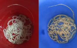 Hai mẹ con cùng xổ ra sán xơ mít dài hơn 7m
