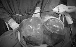 Cắt bỏ tử cung và khối u xơ năng hơn 5kg cho một phụ nữ