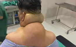 Cơ thể biến dạng sau nhiều năm nghiện rượu