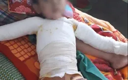 Chơi bật lửa, bé trai bị lửa bén cháy quần áo gây bỏng nặng