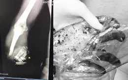 Sơ ý lúc làm việc, người đàn ông bị máy vò chè quấn nát tay