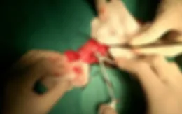Ung thư dương vật - không chủ quan khi sinh thiết lành tính