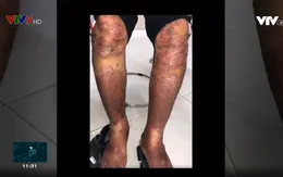 Cẩn trọng khi tự ý sử dụng thuốc y học cổ truyền chữa bệnh