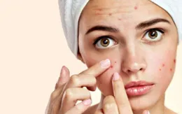 Bí kíp đẩy lùi mụn trứng cá trong những ngày “đèn đỏ”