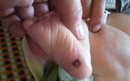 Bé 1 tháng tuổi mắc giang mai bẩm sinh từ mẹ