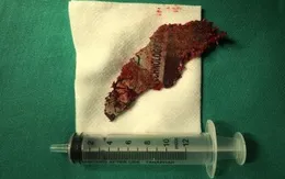 Cứu người đàn ông bị lưỡi của máy cầm tay gãy, cắm vào mặt