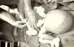 Mắc thoát vị màng não tủy, bé sơ sinh mang khối u khổng lồ ở mông