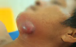 Cẩn trọng với những vết sâu răng