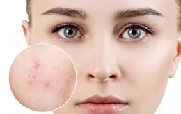 Bí quyết điều trị hiệu quả mụn trứng cá