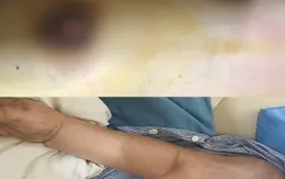 Đắp lá chữa ung thư vú, một phụ nữ bị di căn xương giai đoạn cuối