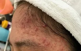 Các bệnh da liễu thường gặp vào mùa hè