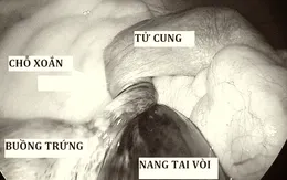 Cẩn trọng với xoắn buồng trứng ở bé gái