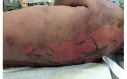 Xử trí đúng cách khi dị ứng thuốc