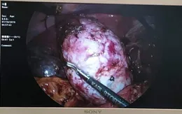 Nội soi lấy nang mật chủ bằng nắm tay cho hai bé chưa đầy 2 tháng tuổi