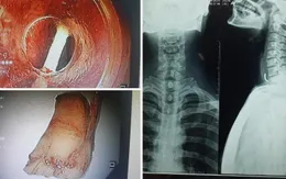 Ăn bún giò, người đàn ông bị xương lợn chắn ngang thực quản