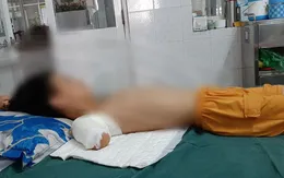 Đi câu cá dưới đường điện cao thế, bé trai bị phóng điện phải cắt cụt tay
