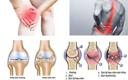 Thực phẩm bảo vệ sức khỏe viên xương khớp An Khớp Xà