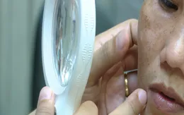 UV ở mức nguy hại, người bị rám má, viêm da tăng mạnh