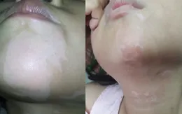 Phương pháp mới đem lại hi vọng điều trị cho bệnh nhân bạch biến