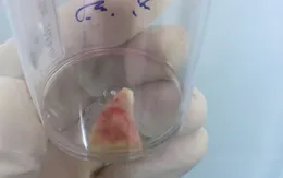 Húp vội bát cháo lòng, người phụ nữ bị xương lợn rơi vào phế quản