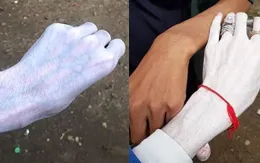 Da trắng như mắc bệnh bạch tạng vì sử dụng kem làm trắng