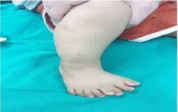 Hy hữu: Bé trai 1 tuổi bàn chân phải có 9 ngón