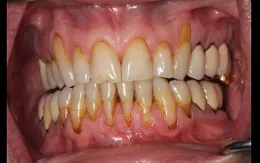 Thuốc lá điện tử có thể gây viêm nướu, các bệnh răng lợi khác