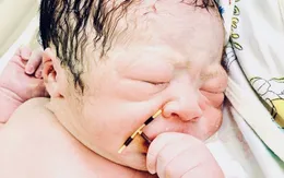 Hy hữu: Mẹ đặt vòng tránh thai, con vẫn nhất định ra đời, mang theo luôn vòng tránh thai "trả" mẹ